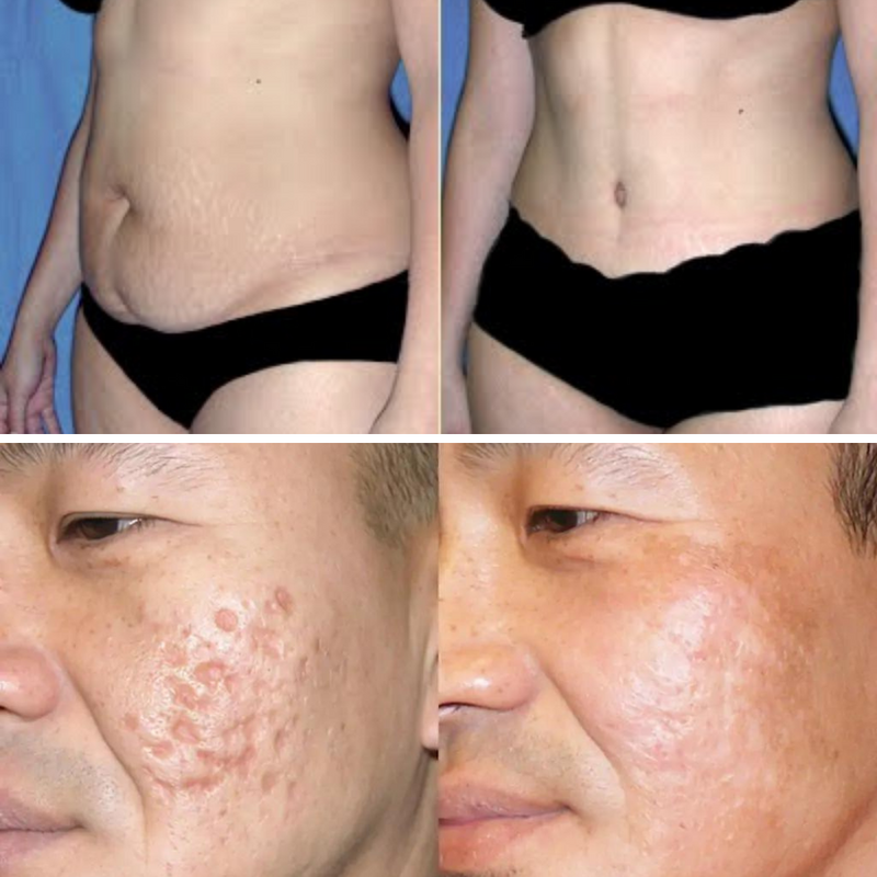 Scar Remove™ Removedor de Cicatrizes, Estrias e Marcas na Pele - Tenha um Corpo Lindo Novamente