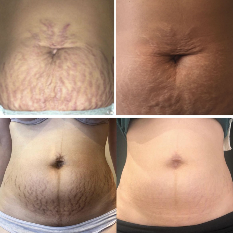 Scar Remove™ Removedor de Cicatrizes, Estrias e Marcas na Pele - Tenha um Corpo Lindo Novamente