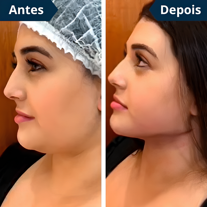 FaceLift™ Redutor de Rugas e Papada - Tenha um rosto LINDO novamente sem Papadas + Creme Exclusivo de Brinde