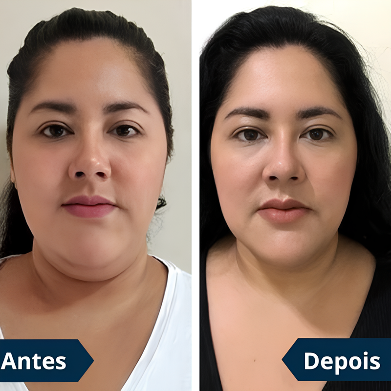 FaceLift™ Redutor de Rugas e Papada - Tenha um rosto LINDO novamente sem Papadas + Creme Exclusivo de Brinde