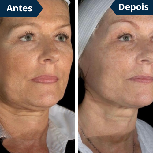 FaceLift PRO™ Redutor de Papada & Gordura Facial + Creme Aloe Vera de BRINDE