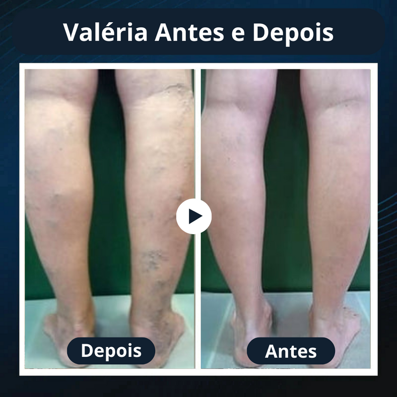 VariLift™ Redutor e Removedor de Varizes - Tenha um Corpo Saudável novamente