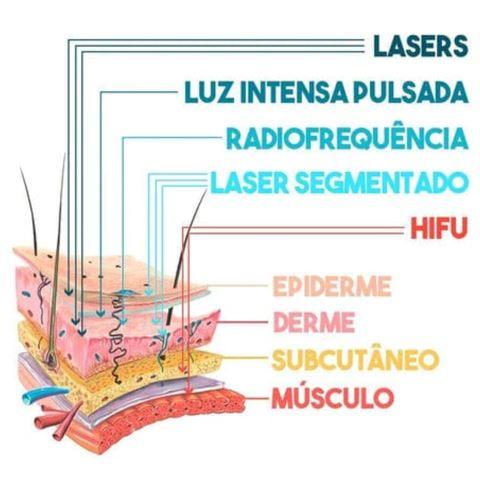 Lifting Microfocado Mini Hifu